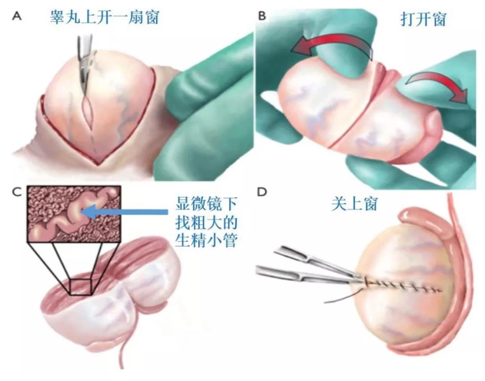 显微镜下睾丸取精术?蛋蛋上?显微?手术?